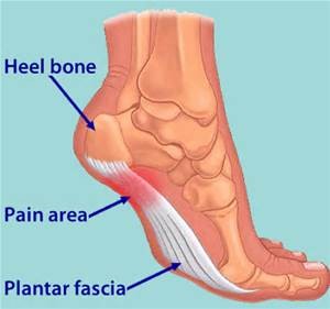 Illustration of foot with heel bone, pain area, and plantar fascia