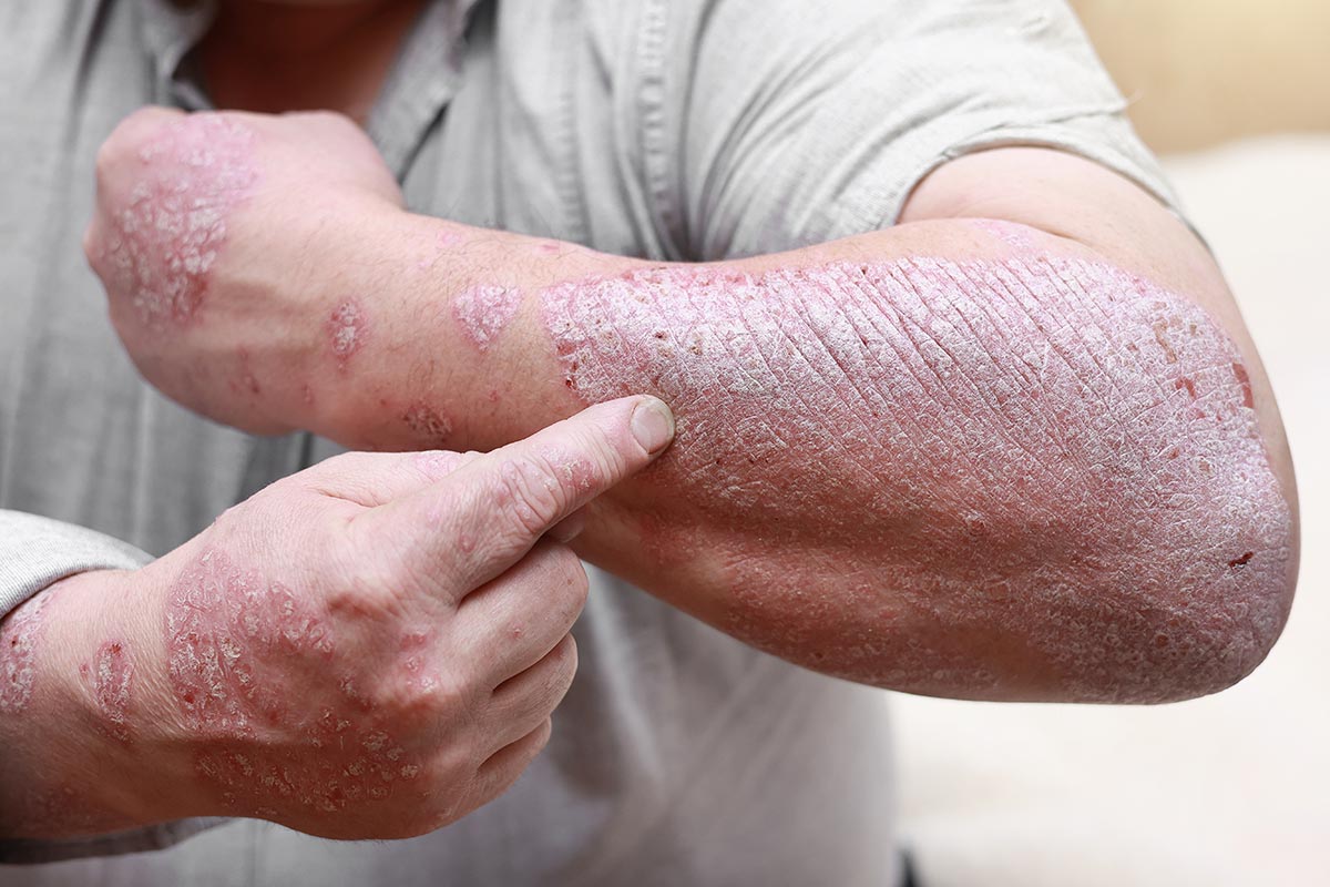 Man with acute psoriasis on his arm